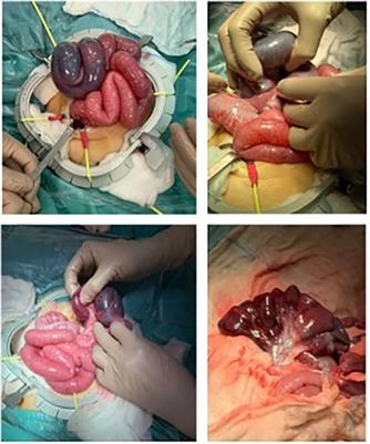 Case Report: An unusual case of wide ileoileal intussusception associated with intestinal volvulus in a 8-months-old infant